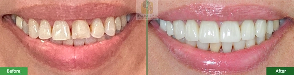Porcelain Veneers