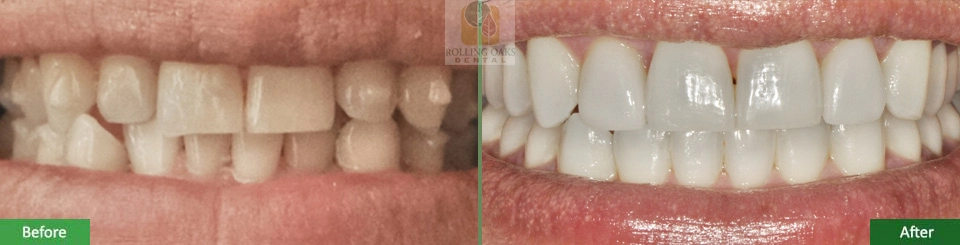 Porcelain Veneers