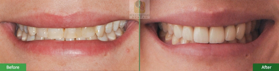Porcelain Veneers