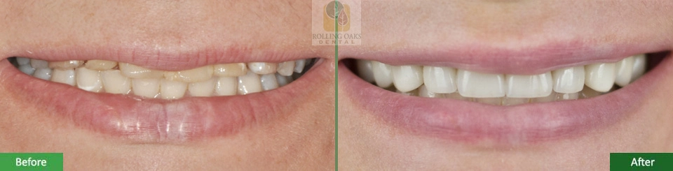 Porcelain Veneers