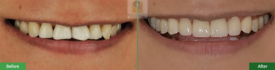 Porcelain Veneers