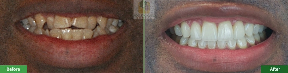 Porcelain Veneers