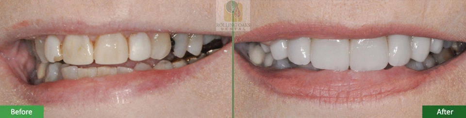 Porcelain Veneers