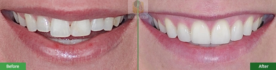 Porcelain Veneers