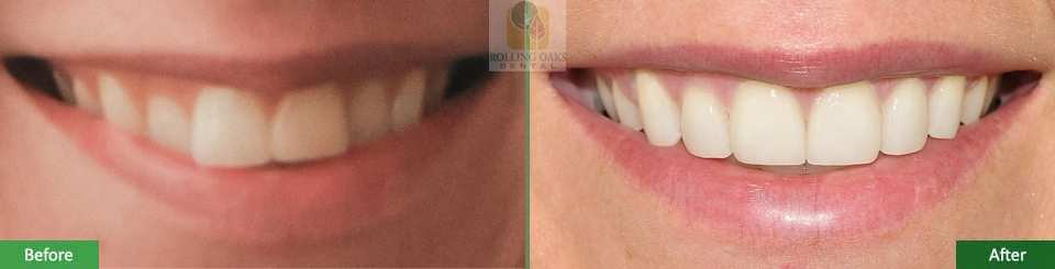Porcelain Veneers