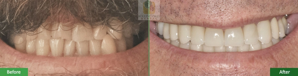 Porcelain Veneers