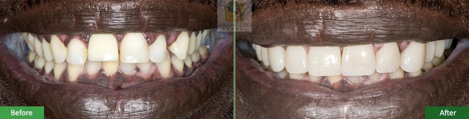 Porcelain Veneers