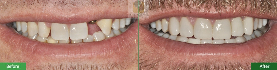 Porcelain Veneers