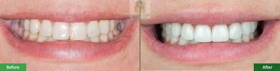 Porcelain Veneers