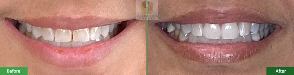 Porcelain Veneers