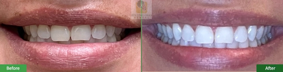 Teeth Whitening by Kor® 1