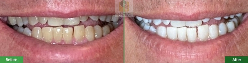 Teeth Whitening by Kor® 10