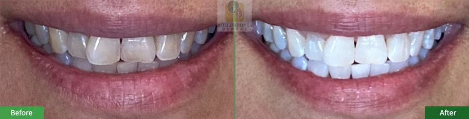 Teeth Whitening by Kor® 11