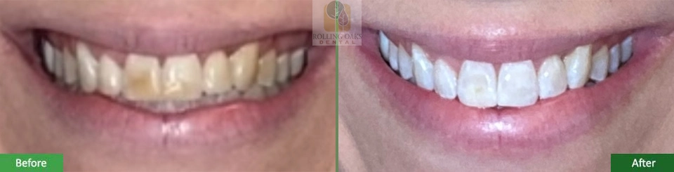 Teeth Whitening by Kor® 2