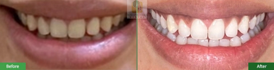 Teeth Whitening by Kor® 4