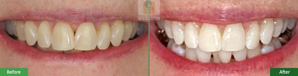Teeth Whitening by Kor®6