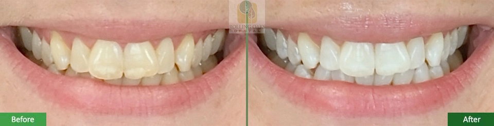 Teeth Whitening by Kor®7