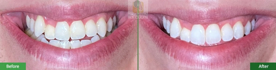 Teeth Whitening by Kor®8