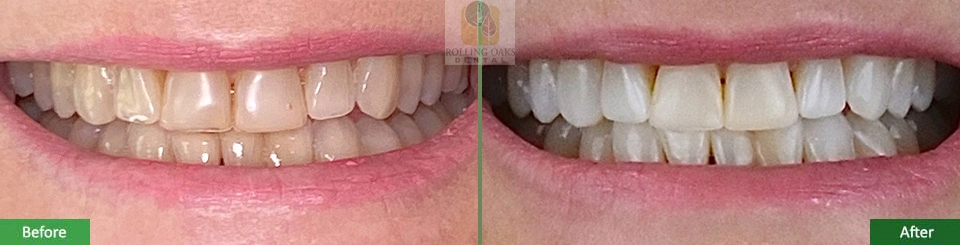 Teeth Whitening by Kor®9 1