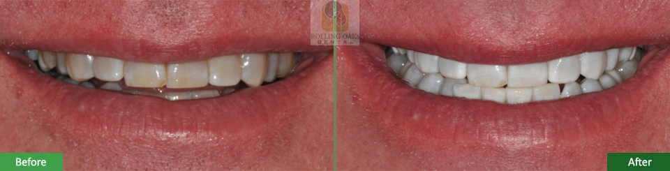 Teeth Whitening by Kor®9