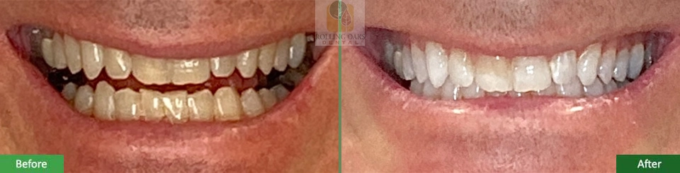 Teeth Whitening by Kor®9