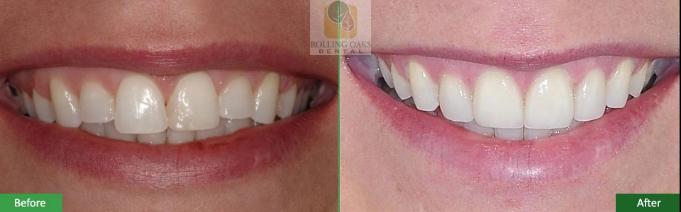 cosmetic smile gallery