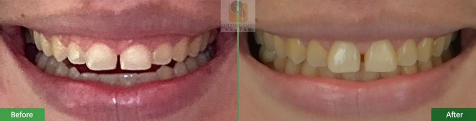 Esthetic Crown Lengthening