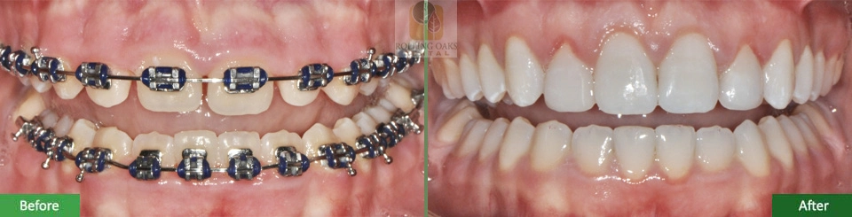 Esthetic Crown Lengthening