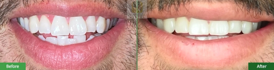 Invisalign
