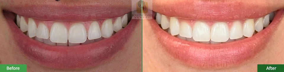 Invisalign