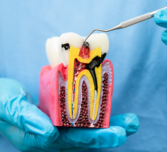 Root Canals