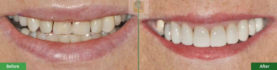 Porcelain Veneers