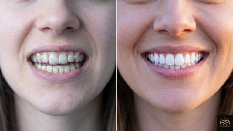Invisalign Treatment in Garden Ridge, TX - Orthodontic Solution